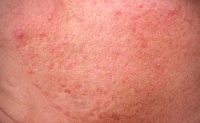 Rosacea
